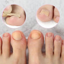 Adesivo para Unhas | Fungos e Unhas Encravadas | 32 Un